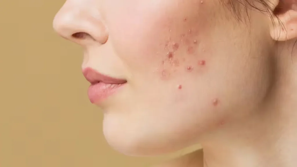 Acne Treatment service chevy chase