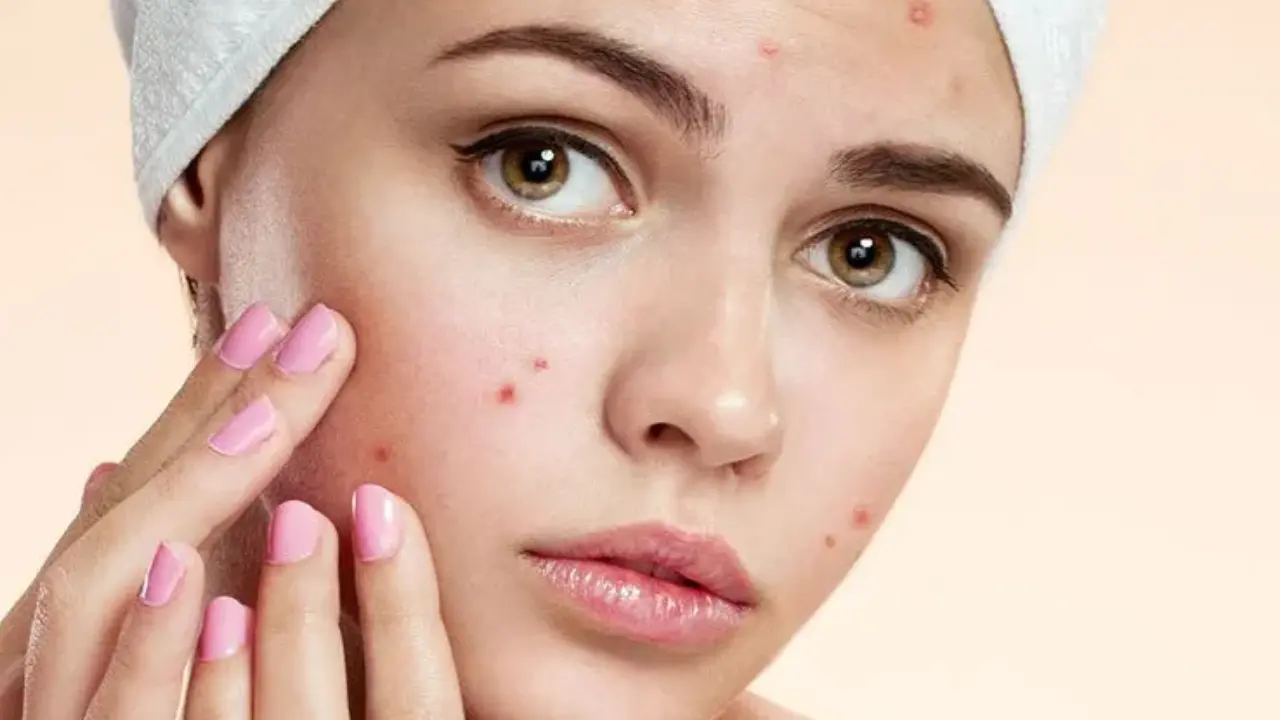 Acne Treatment in MD