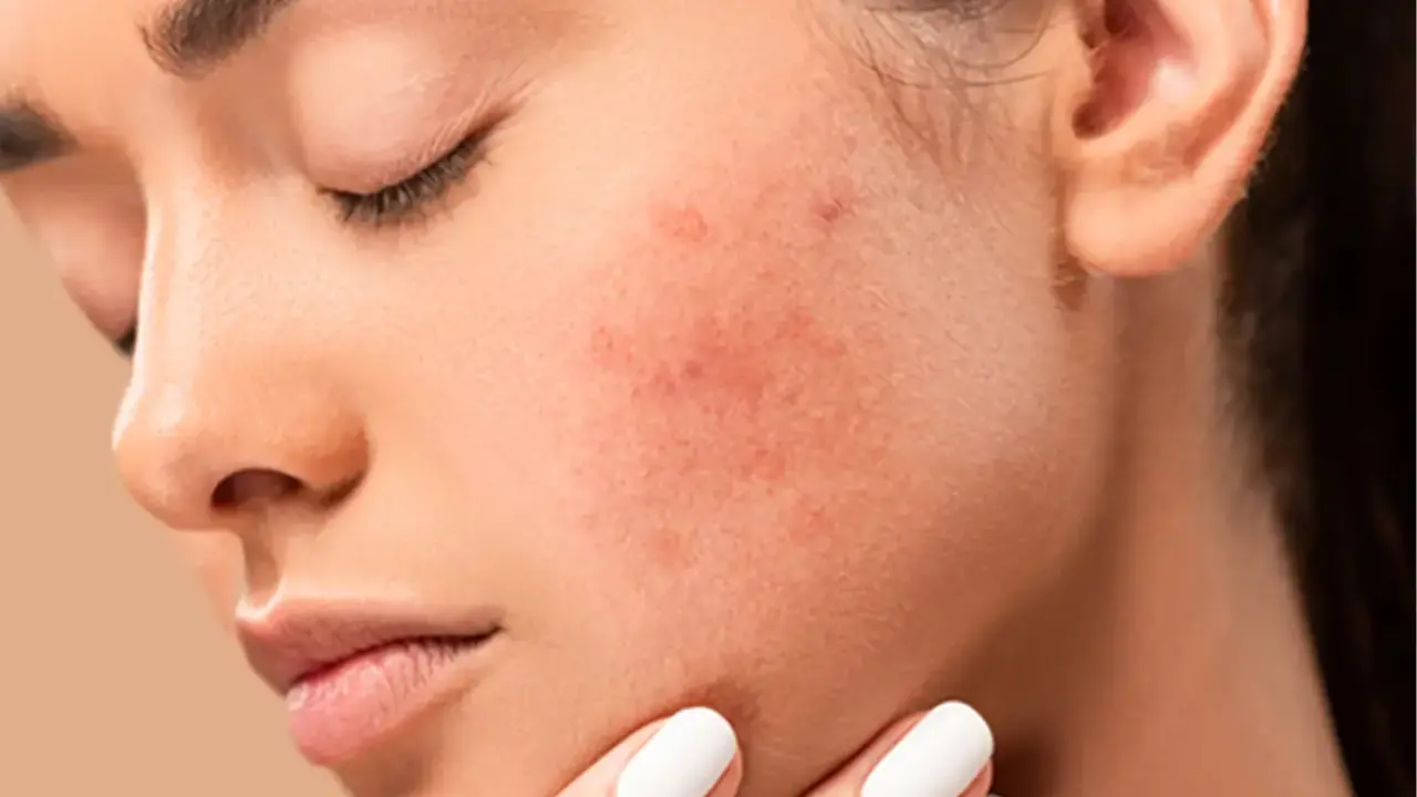 Acne Treatment in Maryland