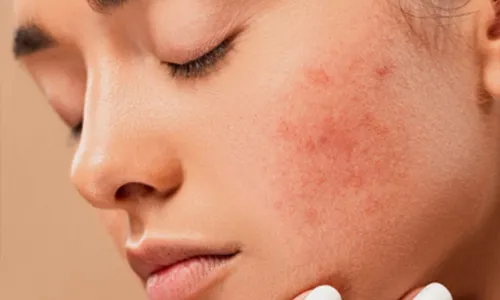 Rosacea Treatment Chevy Chase