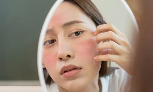 Rosacea Treatment Chevy Chase MD