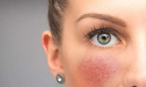 Rosacea Treatment in Chevy Chase